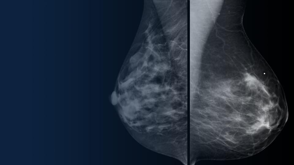 AI mammography is advancing clinical insights for breast care | GE ...