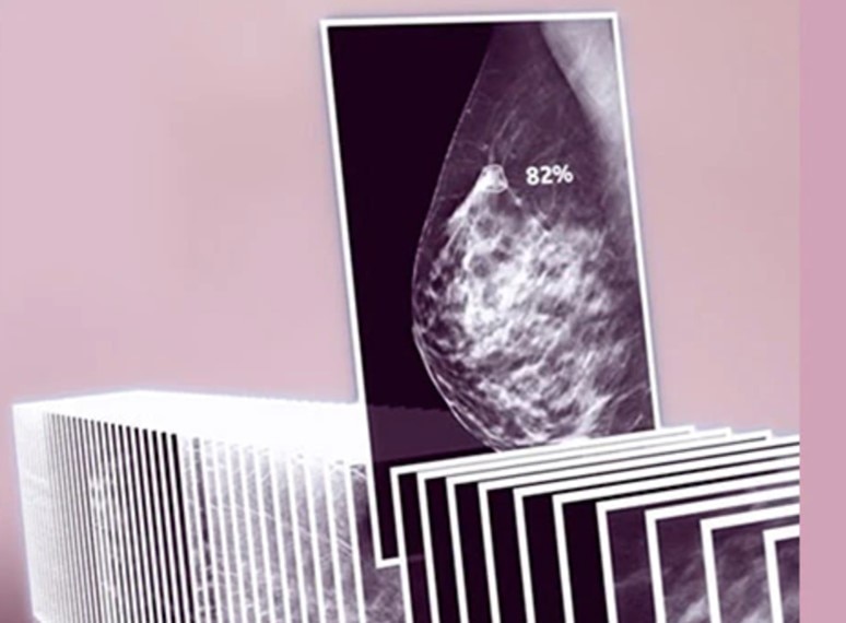 Personalizing breast cancer screening in the era of precision medicine
