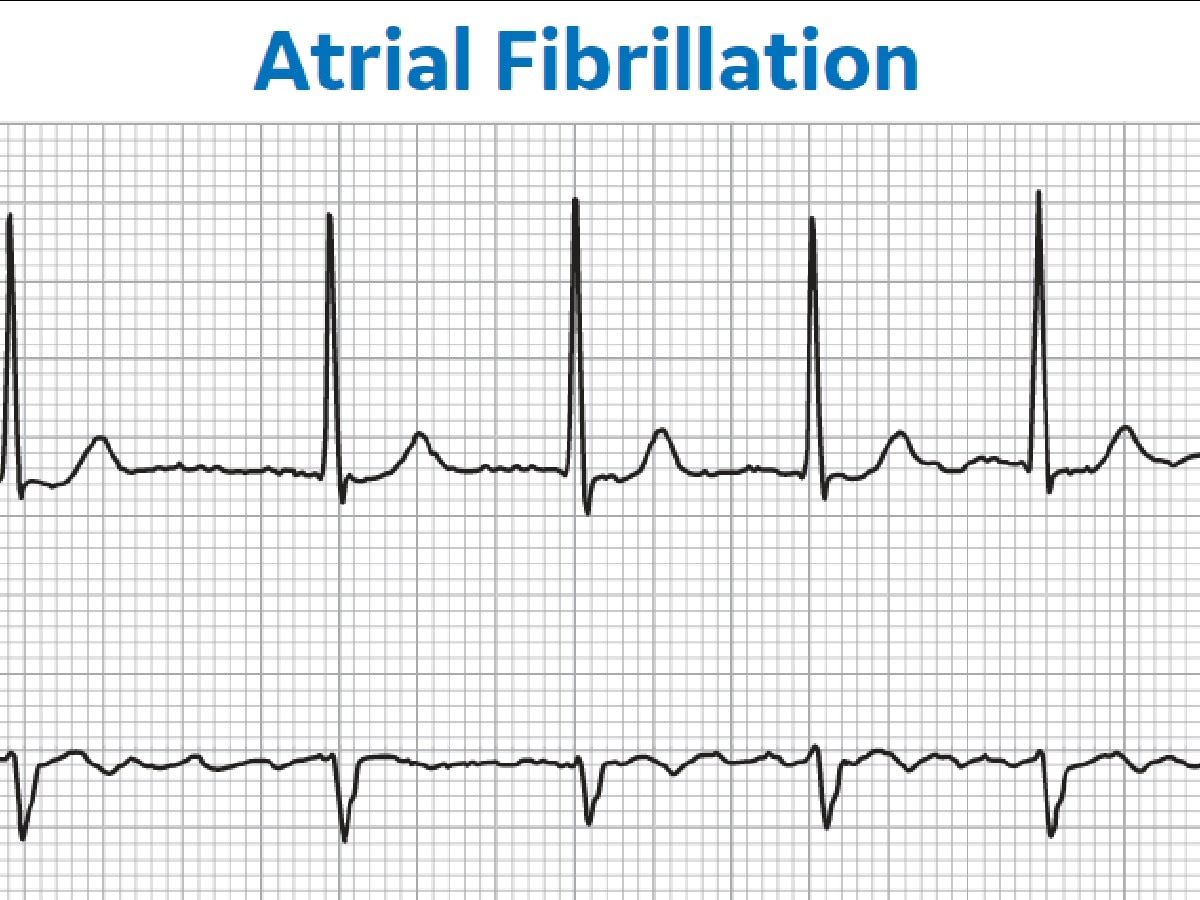 A Quick-Reference Guide to Using ECG for Atrial Fibrillation Management ...