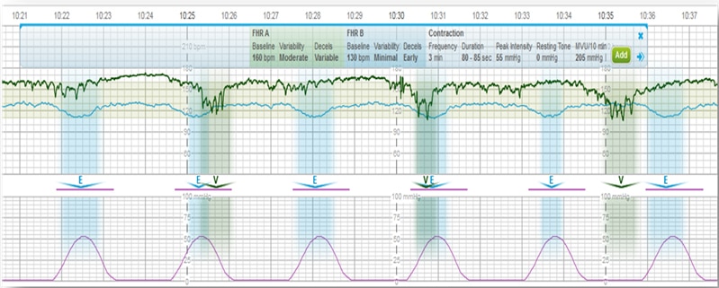Centricity Perinatal Fetal Strip Monitor