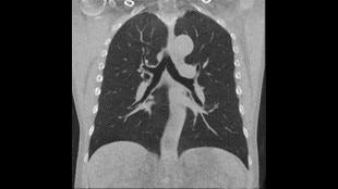 0.08 mSv chest clinical image
