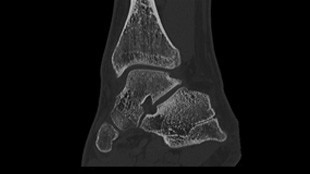 Calcaneal bone clinical image