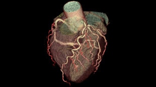 High resolution aorta stent