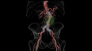 High resolution aorta stent