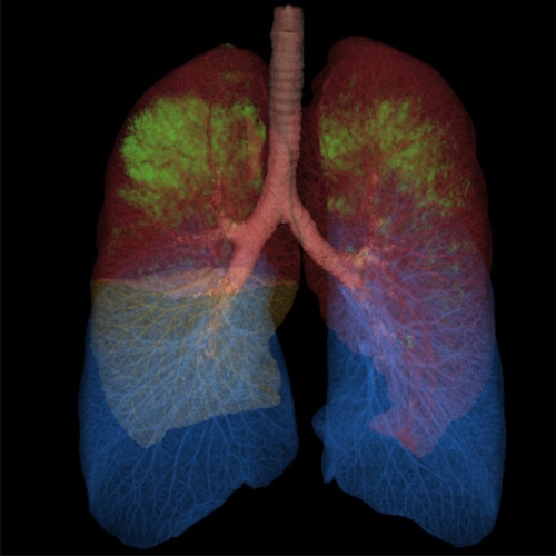 thoracic vcar lungs.