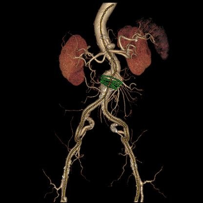 GE Healthcare (T)EVAR Assist