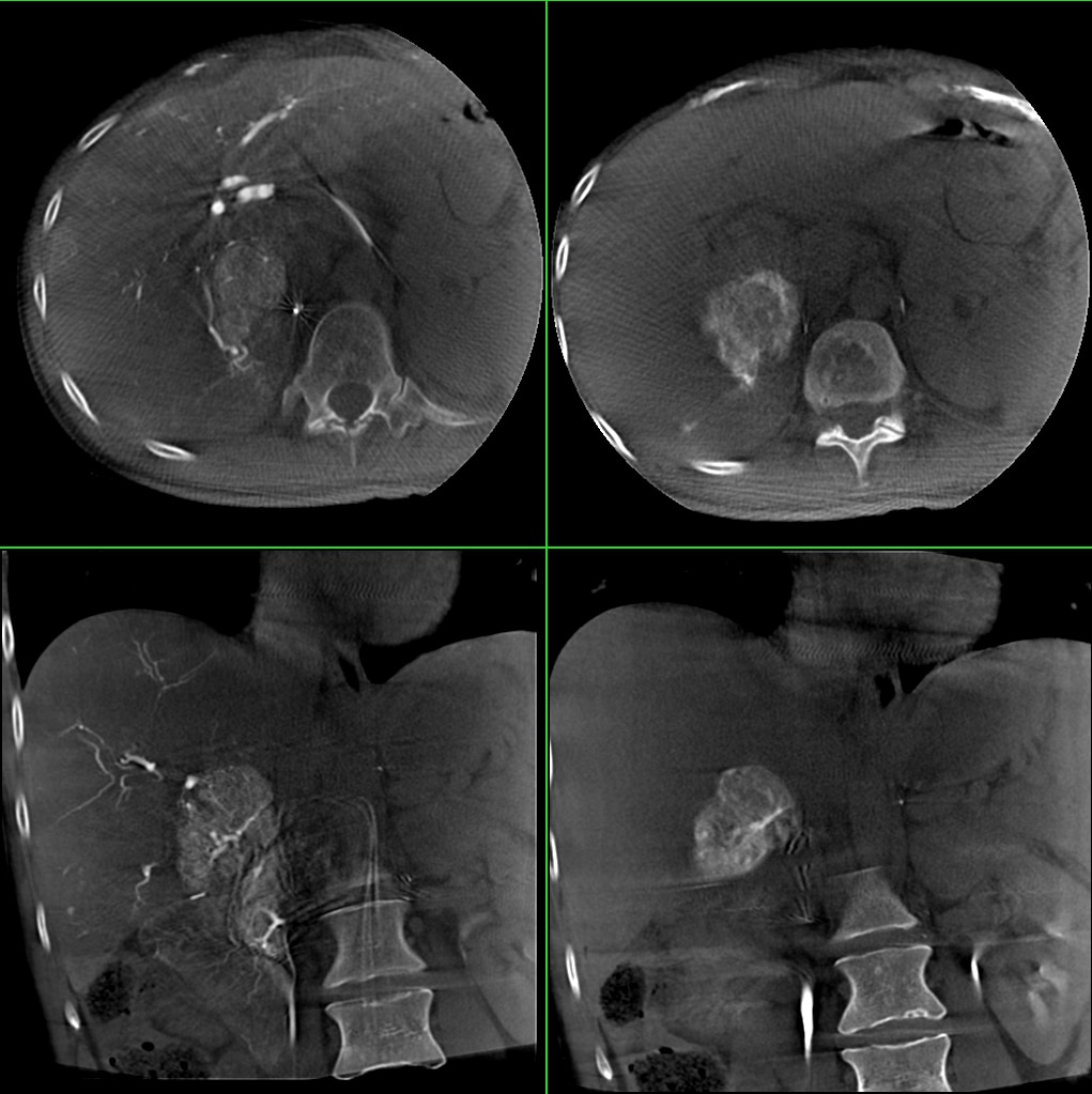 GE Healthcare Innova IGS 540 Liver Emobolization