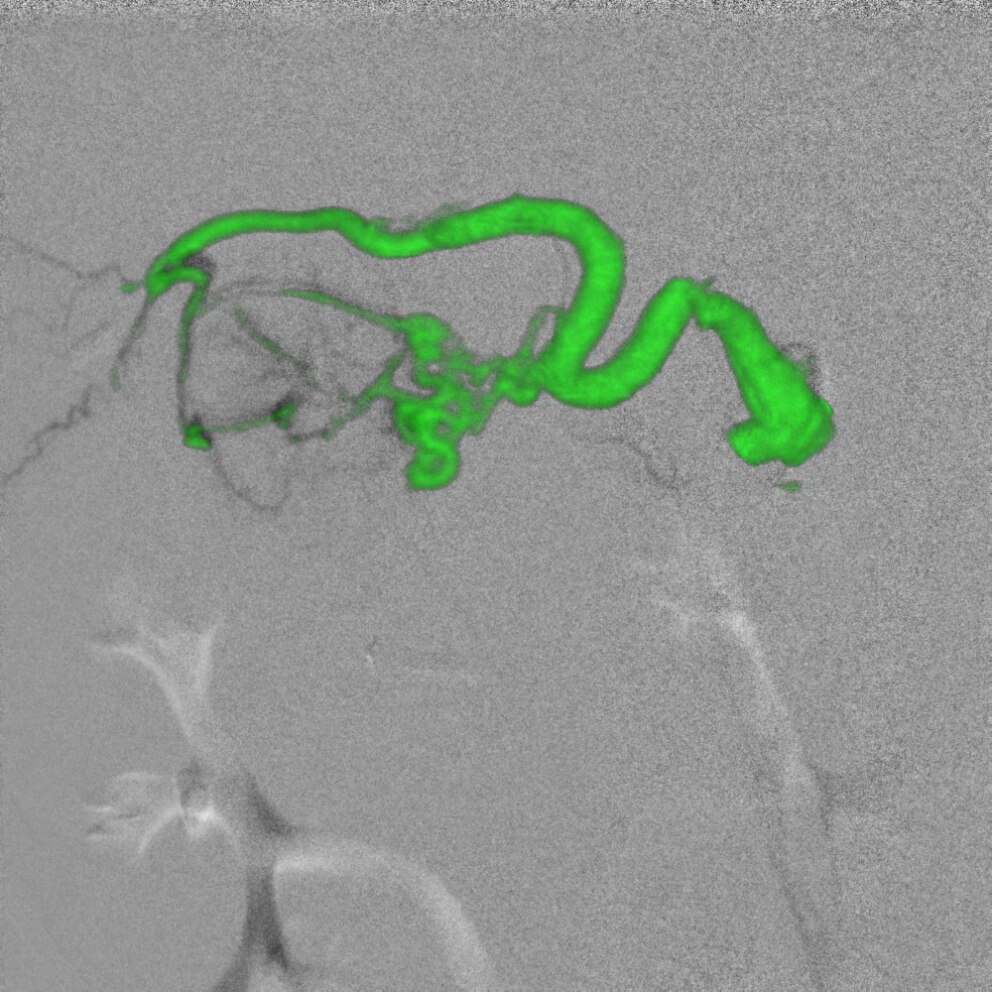 GE Healthcare Innova IGS 540 Liver Emobolization