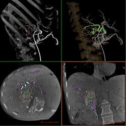 GE Healthcare Innova IGS 540 Liver Emobolization