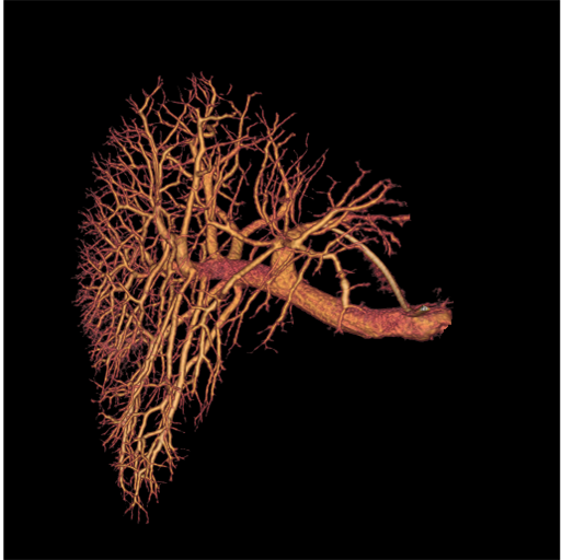 GE Healthcare Innova IGS 540 Portal Vein Embolization