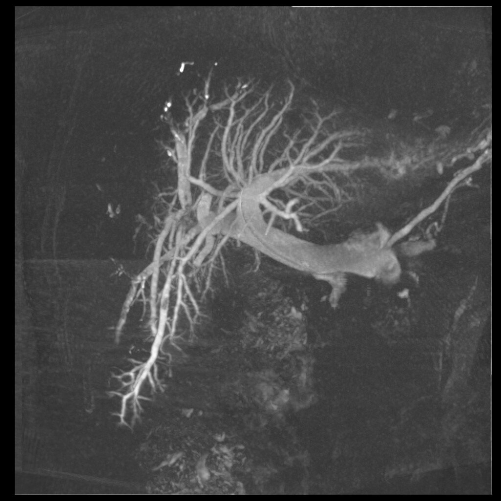GE Healthcare Innova IGS 540 Portal Vein Embolization