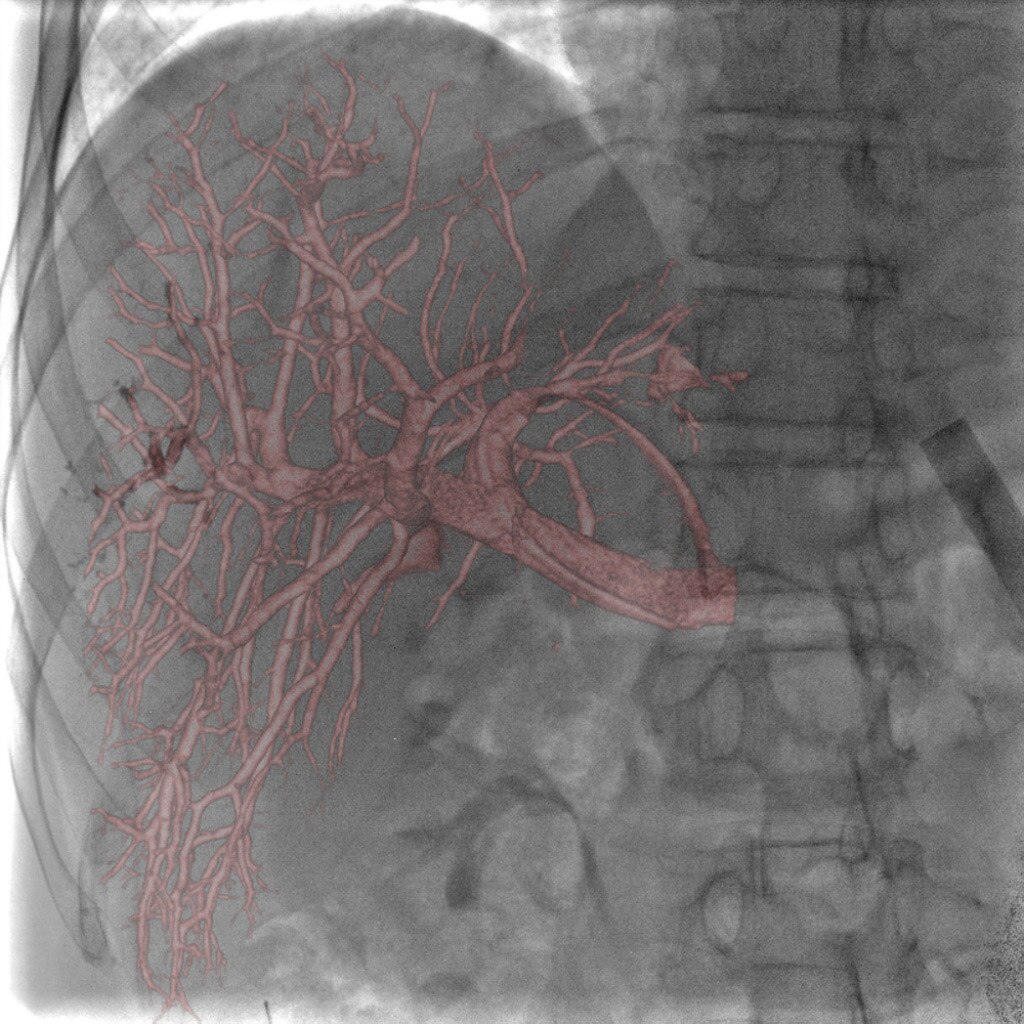 GE Healthcare Innova IGS 540 Portal Vein Embolization