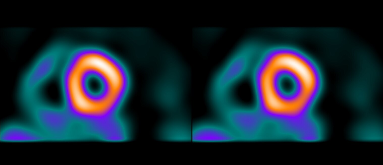 GEHCMyoSPECTPWPMyocardialBloodFlowImage1