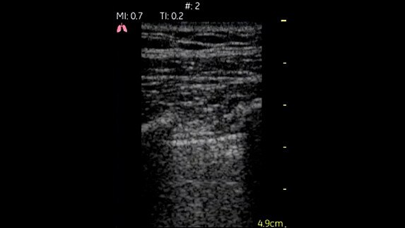 hotspot tours-vscan-lung_pleural-space_1_jpg