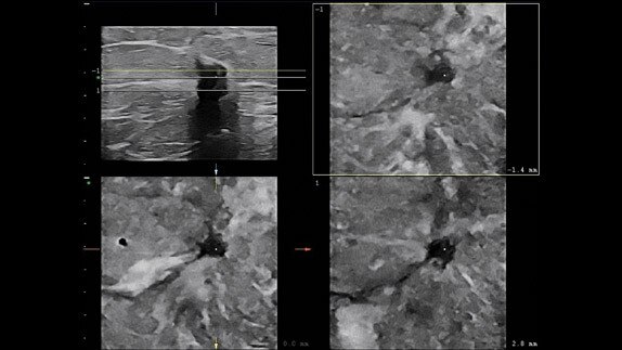 hotspot tours-logiq e9-speckle-reduction_jpg