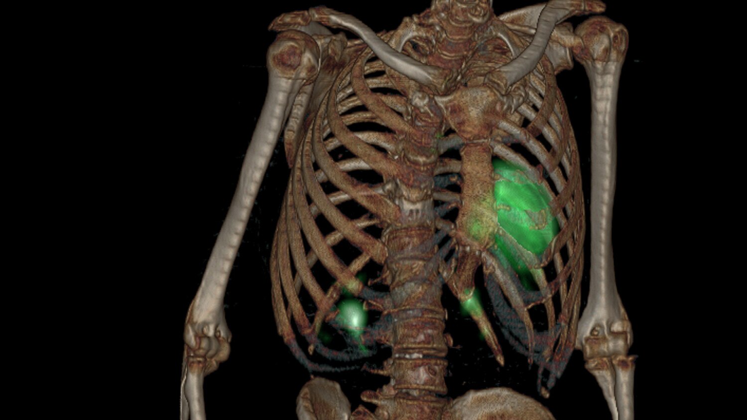 Interventional Advanced Visualization | GE HealthCare (Thailand)