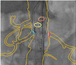 product-product-categories-Intervantional - 2016-evar_12.jpg