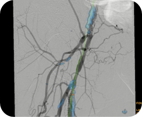 product-product-categories-Intervantional - 2016-vessel_13.jpg