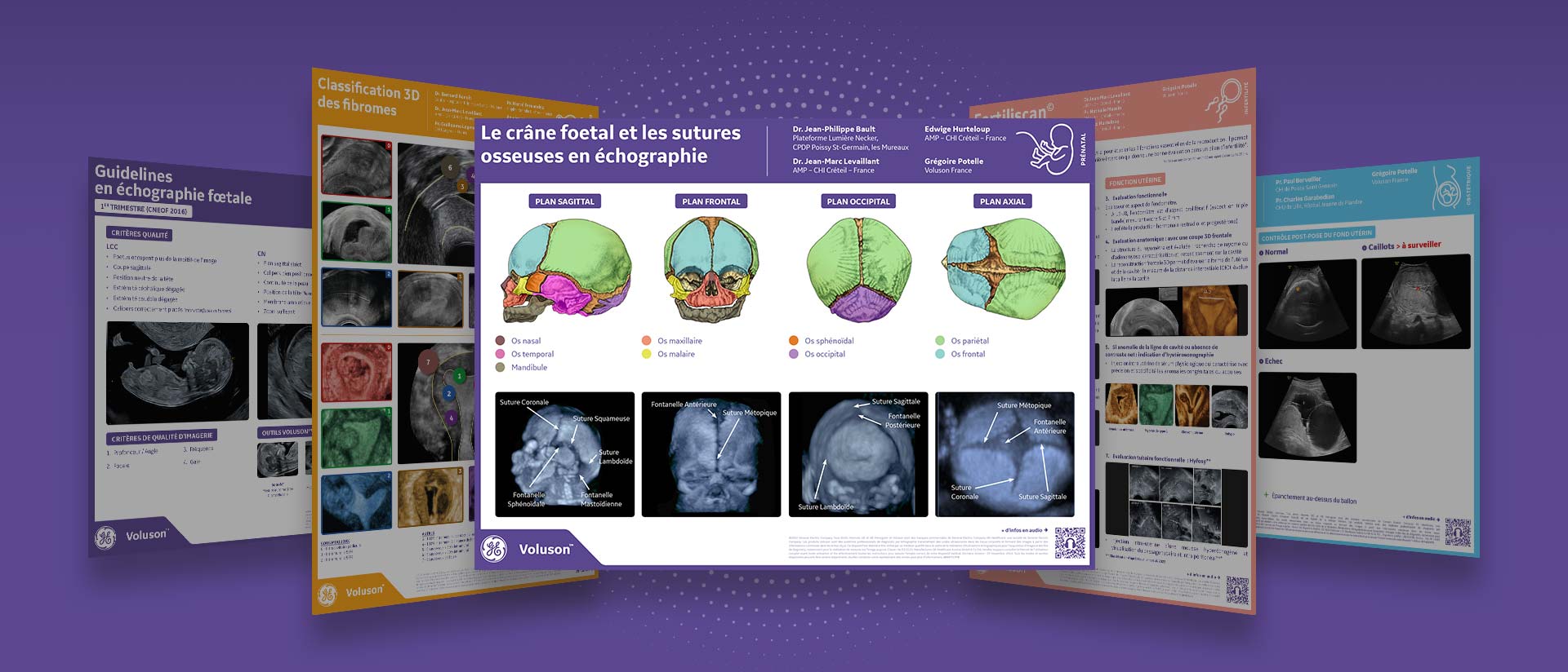POSTERS-VOLUSON-A3-GEHEALTHCARE-prenatal-crane-foetal-sutures-osseuses-v2