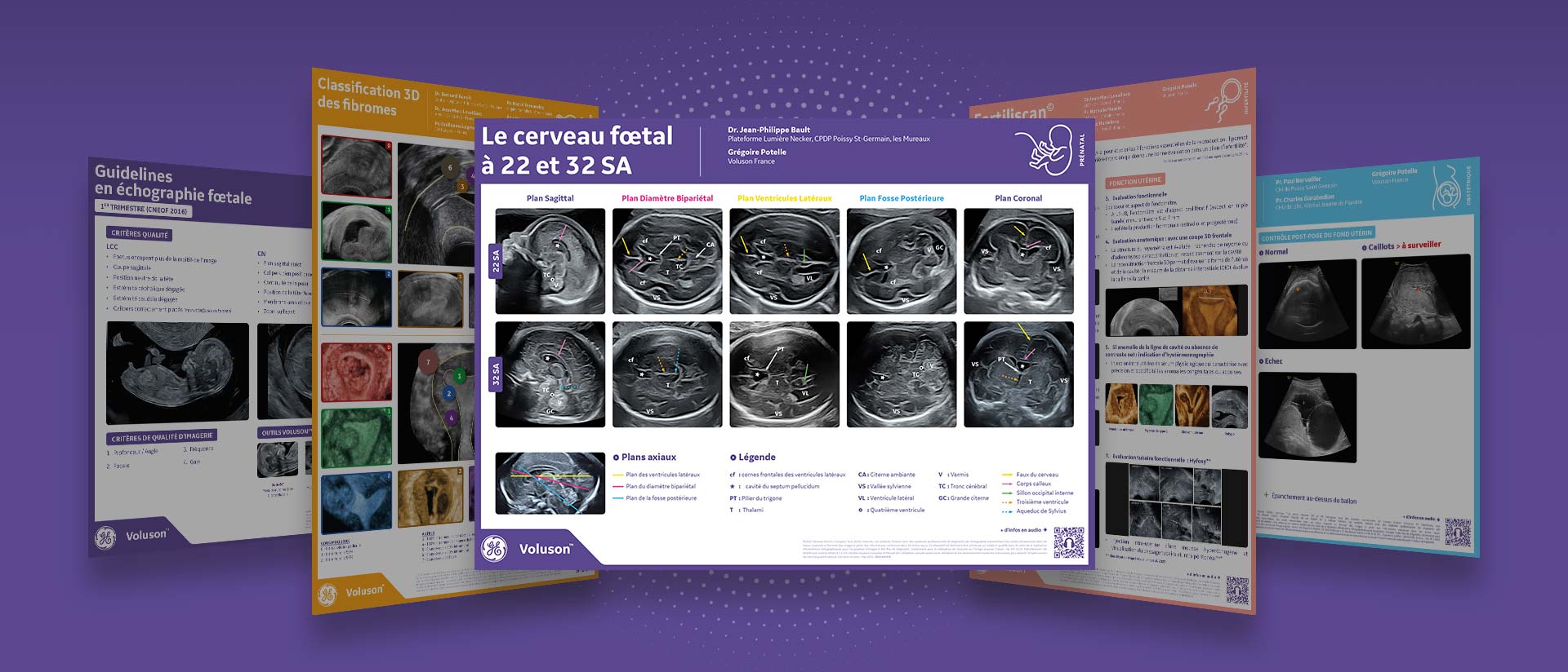 POSTERS-VOLUSON-A3-GEHEALTHCARE-prenatal-cerveau-foetal-22-32-SA-mockup-full