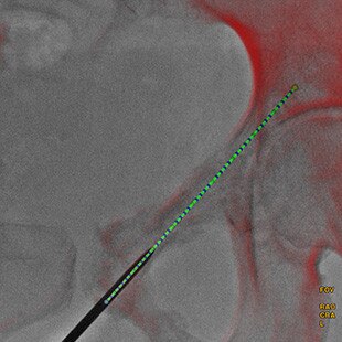 product-product-categories-Intervantional - 2016-needle_22.jpg
