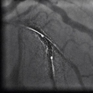 product-product-categories-Intervantional - 2016-pci_13.jpg