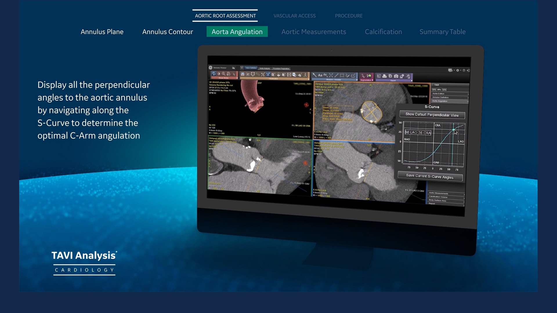 AW-TAVI-Analysis-full-width-video
