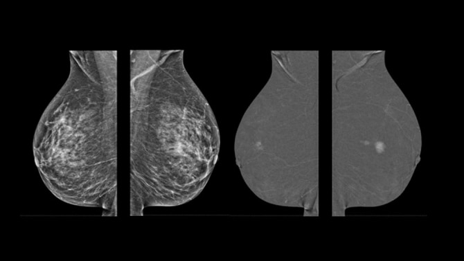 Diagnostic Breast Imaging 第2版 Diagnostic Imaging: Breast: 9780323548120: Medicine & Health