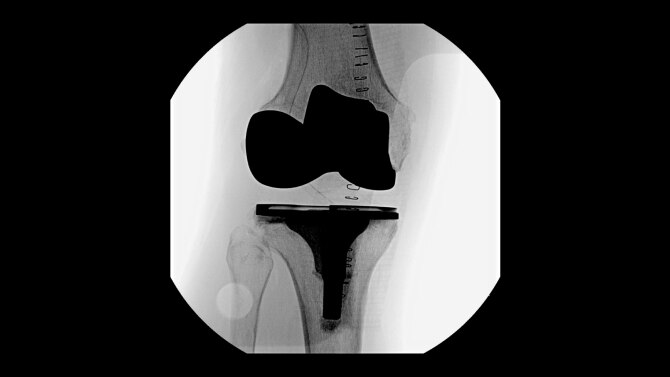 コンパス顔面骨骨折の治療 : Clinical Operation Manua… Outcomes of modified arthrocentesis using concentric needle