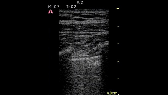 hotspot tours-vscan-lung_pleural-space_1_jpg