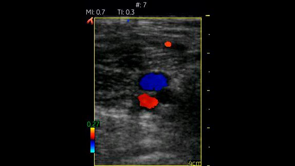hotspot tours-vscan-popliteal vessels with color flow_jpg