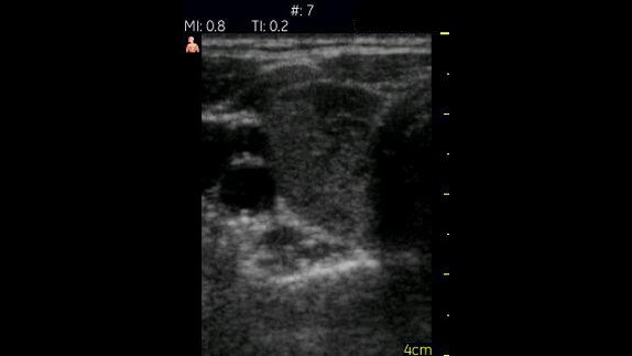 hotspot tours-vscan-thyroid_jpg