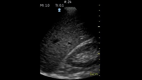hotspot tours-vscan-hepatorenal-space_jpg