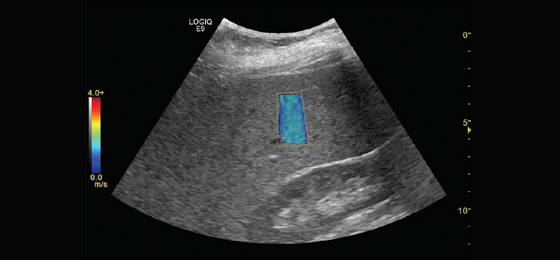 LOGIQ E9 XDclear 2.0 | GE Healthcare (United States)